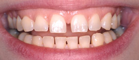 New York City dental implants can erase the gaps between teeth