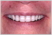 Dr. Woloch, Manhattan’s premiere dental implant specialist