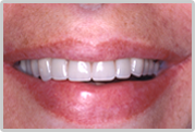 Dr. Woloch, Manhattan’s premiere dental implant specialist